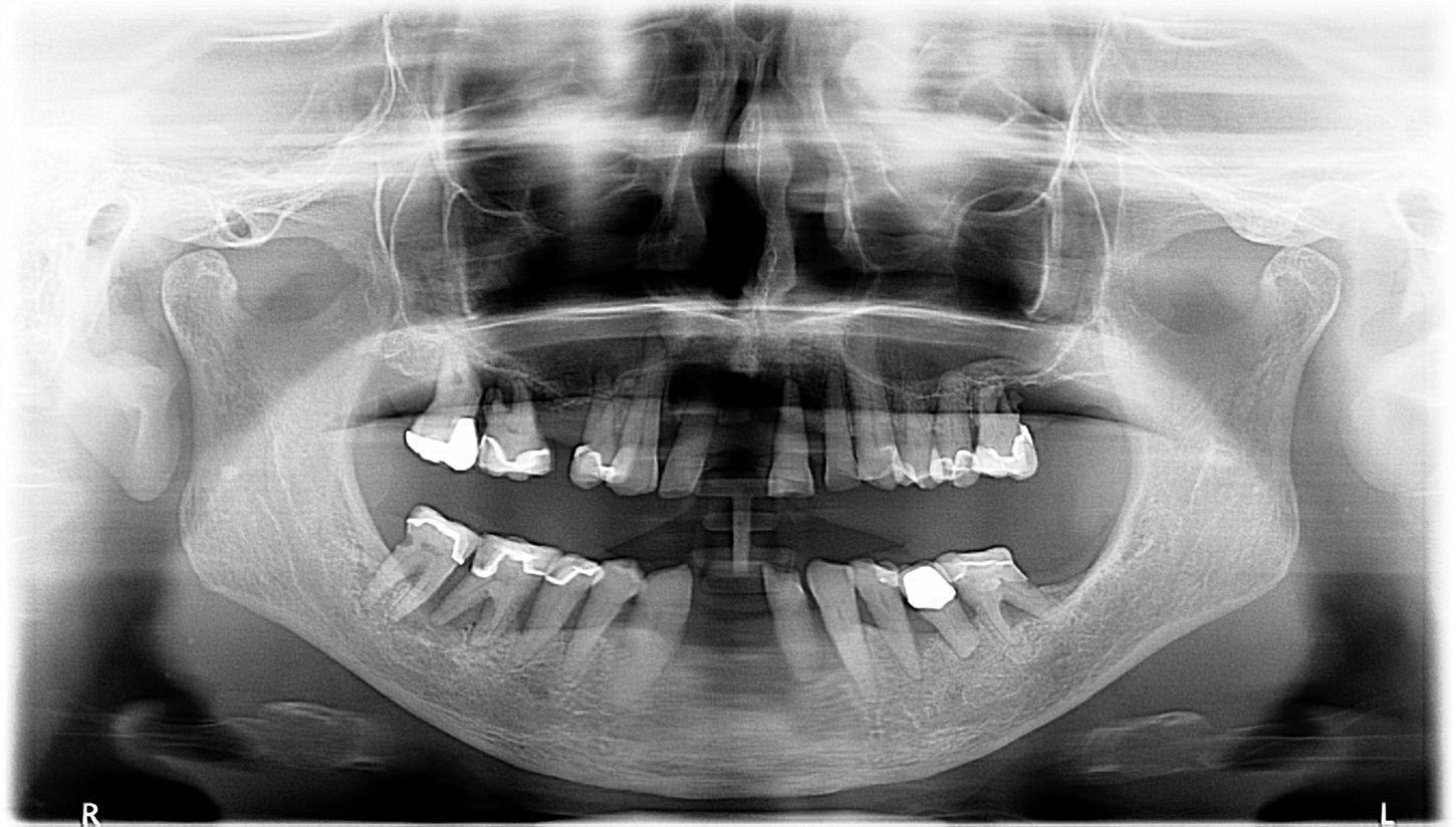 1. preOP x ray.JPG?wid=1450